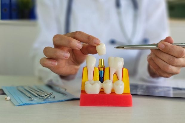 6 avantaje ale implantului dentar