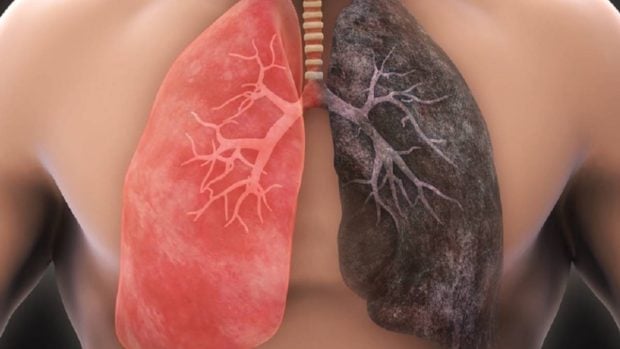 Spitalul „Victor Babeș” Timișoara, apel pentru un program de prevenție și screening în cancerul pulmonar: „Un român moare în fiecare oră”