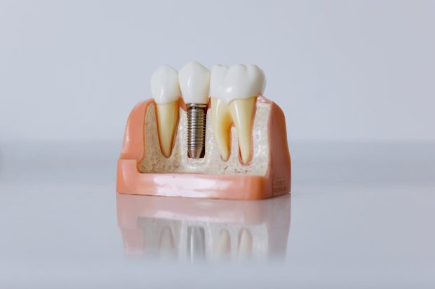 Avantajele tratamentului cu implant dentar