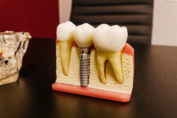 5 avantaje ale implantului dentar