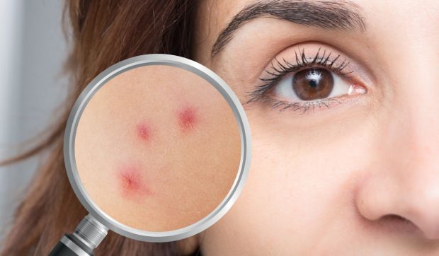 Să nu te plângi niciodată că ești singur: pe piele trăiesc mii de „musafiri” invizibili. Ce este Demodex, acarianul care umblă noaptea pe fața ta