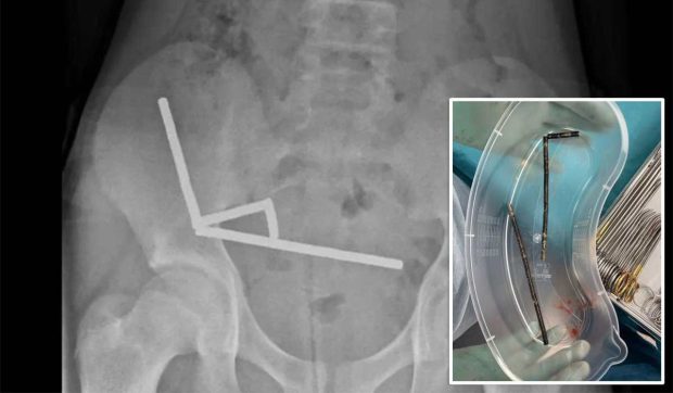 Băiat de 13 ani, operat de urgență după ce a înghițit 100 de magneți cumpărați de pe Temu