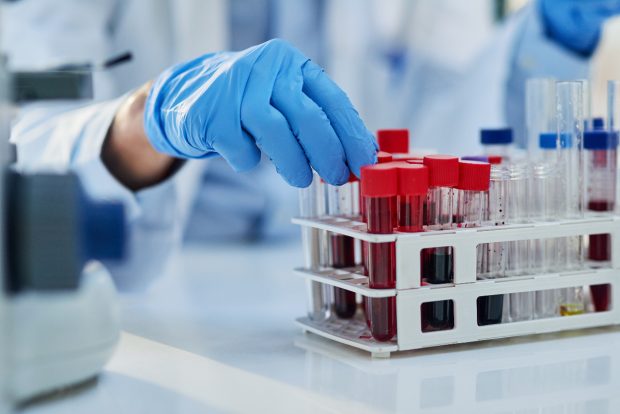 Primul test de sânge pentru diagnosticarea sindromului oboselii cronice, dezvoltat în Marea Britanie