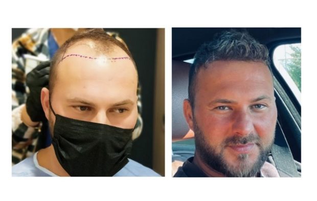 Top 5 Cele Mai Bune Clinici de Transplant de Păr din Turcia: Ghid de Selecție Profesional pentru Rezultate Superioare și Îngrijire Completă
