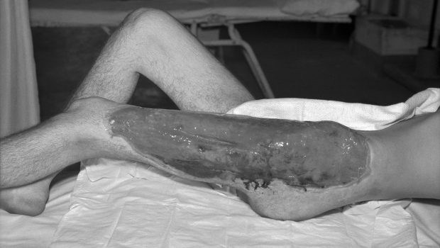 Pe frontul din Ucraina a izbucnit o infecție mortală — gangrena gazoasă, o boală din perioada Primului Război Mondial