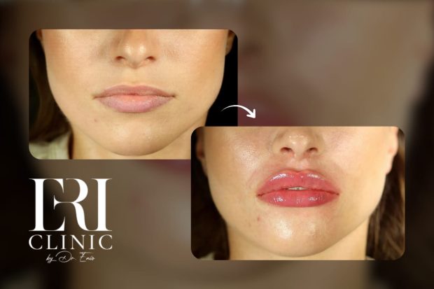 Dăruiește frumusețe: injectarea cu acid hialuronic la Eri Clinic din București, super cadoul dorit