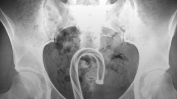 Ce descoperă medicii la radiografii: „Nu mai încercați acasă!”