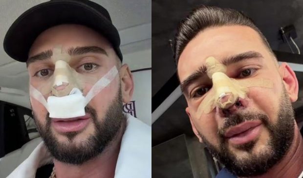 Imagine Stire Cum arată nasul lui Dorian Popa la 12 zile de la operație. Și-a dat bandajul jos: „Cum nici nu am visat” | 2review.ro