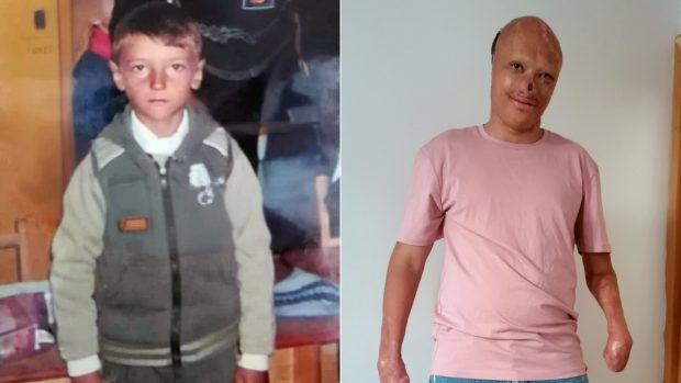 Exemplul de curaj al tânărului mutilat de un incendiu în copilărie. „Nu mă raportez la ce a fost, ci la ce pot construi mai departe”