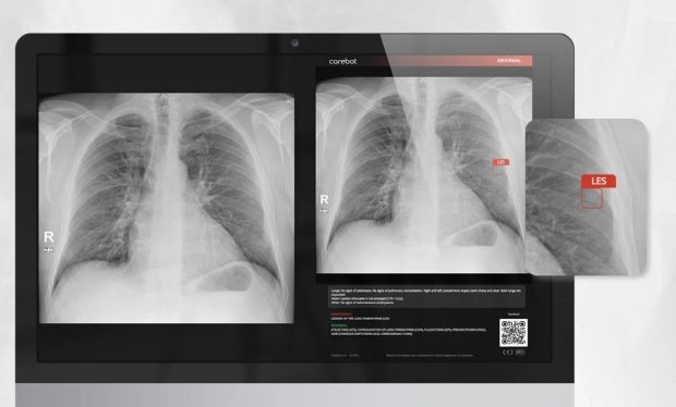 Revoluția silențioasă din radiologia pulmonară care salvează vieți în fiecare zi