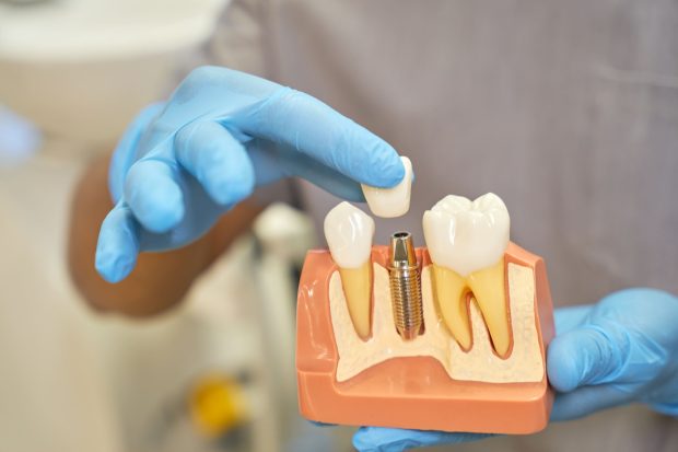 Implanturi dentare premium: Ce diferențiază tipurile de implant