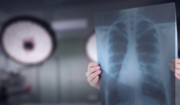 O femeie a fost operată de cancer pulmonar, deși era sănătoasă: „Diagnosticul de tumoră a fost stabilit în mod pripit”