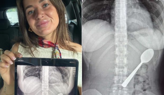 O femeie din Belgia a înghițit o lingură de 17 cm în timp ce mânca iaurt, după ce câinele ei i-a sărit în poală: „Nu mă simțeam deloc rău”