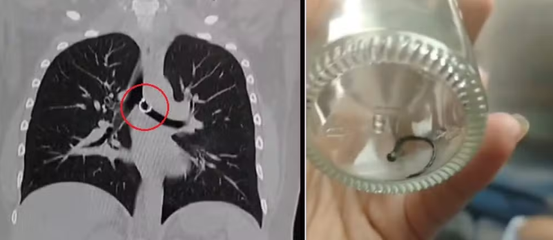 Cum s-a trezit o femeie cu un piercing în plămâni: „Nu mi-aș mai pune unul”