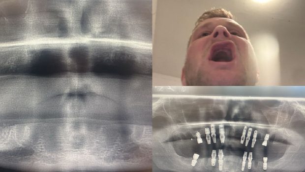 Un bărbat a rămas fără dinți după ce s-a dus în Turcia să-și pună implanturi ieftine: „Cel mai rău lucru care mi s-a întâmplat vreodată”