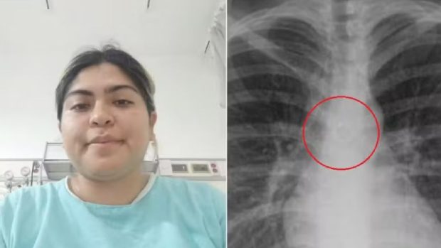 Cum s-a trezit o femeie cu un piercing în plămâni: „Nu mi-aș mai pune unul”