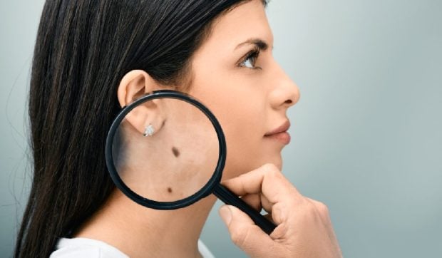 Pericolele metodelor populare pentru îndepărtarea alunițelor și opțiunile gratuite de consultații dermatologice