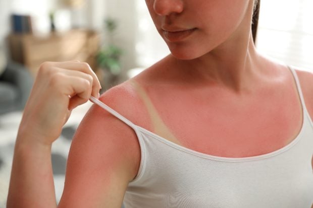 Impactul arsurilor solare asupra sănătății: riscuri și metode eficiente de prevenție