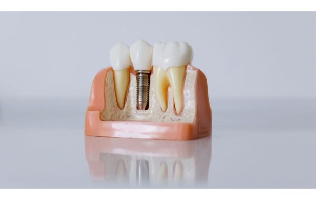 Costurile reale ale unui implant dentar complet și opțiunile moderne All-on