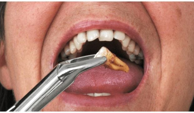Cum se decide extracția dentară și cum pot fi înlocuiți dinții pierduți cu soluții moderne