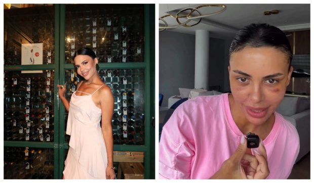 Andreea Popescu dezvăluie transformările după intervențiile estetice: „Am trecut prin momente dificile cu pielea și părul”