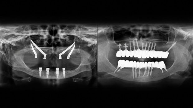 Reconstrucție dentară complexă după un an de tratamente eșuate: când 21 de implanturi nu sunt suficiente